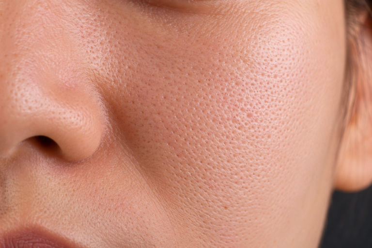 Guarda cosa si nasconde davvero nei pori del viso dopo i 40 anni (Le immagini che i dermatologi non vogliono mostrarti)